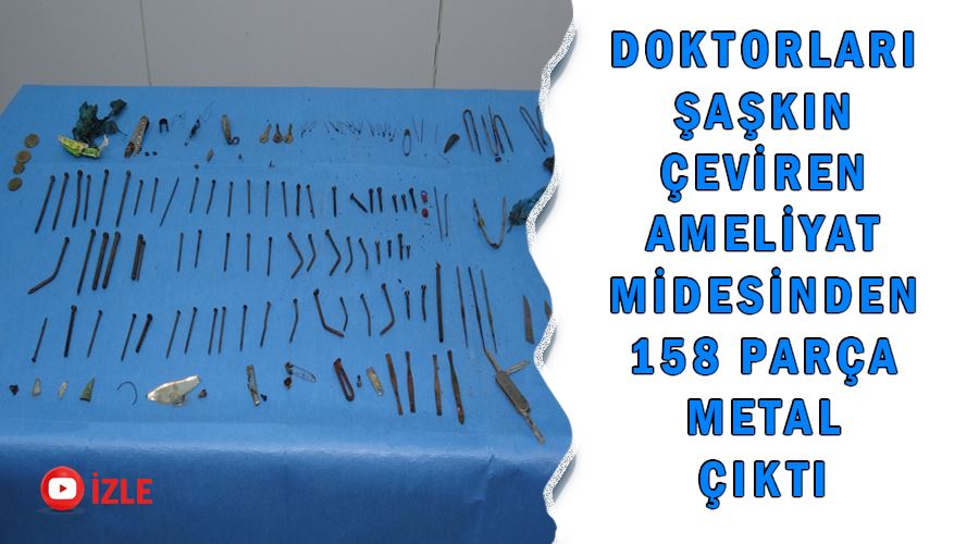 Doktorları şaşkına çeviren ameliyat Midesinden 158 parça metal çıktı
