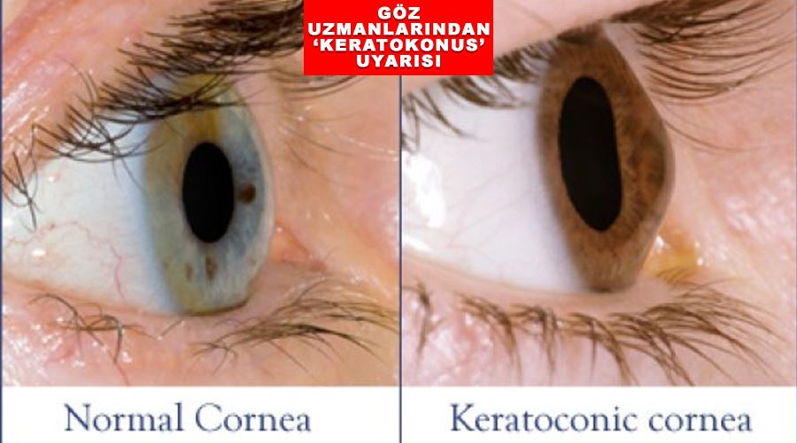 Göz uzmanlarından ‘Keratokonus’ uyarısı